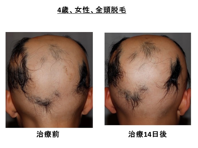 円形脱毛症　病院